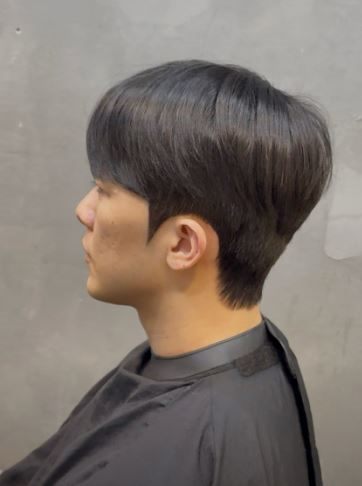 디자인 다운컷 시술 사진