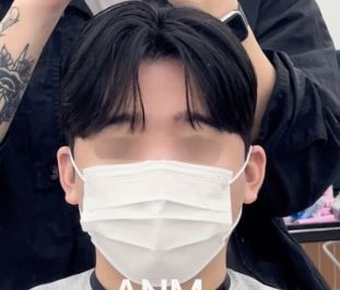 세미리프 시술 사진