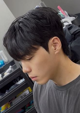 세미리프 시술 사진